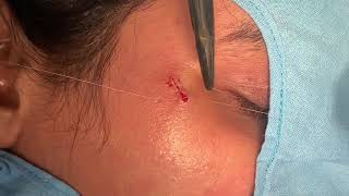 Treatments for ACNE SCAR  Dermabrasion and fine plasticsurgery [upl. by Haidedej270]