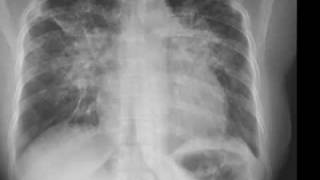 Chest xray Pneumocystis carinii pneumonia lamellar effusion [upl. by Eedoj]