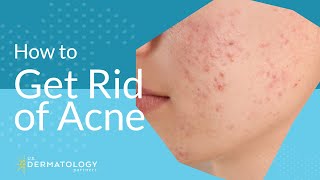 Acne Treatment  Explained by Dermatologist [upl. by Cassandry316]