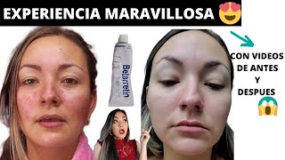 RETINOL ANTES Y DESPUES😱 TRETINOINA MI EXPERIENCIA DESPUES DE 6 MESES betarretin acido retinoico [upl. by Omixam]