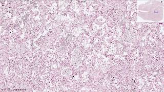 Pneumocystis Jirovecii Pneumonia  Histopathology [upl. by Johnnie]