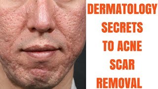 Acne scar treatments ULTIMATE GUIDE [upl. by Abixah193]