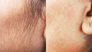 Remove Hair Permanently At Home Natural DIY  Face amp Upper Lip  SuperWowStyle [upl. by Sisi989]