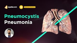 Pneumocystis Pneumonia  Infectious Medicine Lectures  Medical Education  VLearning [upl. by Lou255]