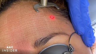 Minimize Acne Scarring With Laser Resurfacing [upl. by Aglo]