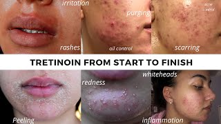 TRETINOIN BEFORE AND AFTER  FULL TRETINOIN EXPERIENCE my journey from start to end Adult Acne [upl. by Iram]