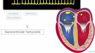 ECG Rhythm Review SVT Atrial Fibrillation Atrial Flutter [upl. by Nnaear]