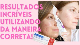 VITACID ACNE Como usar efeitos colaterais funciona Clindamicina  Tretinoína  ACNE E MANCHAS 💦 [upl. by Starbuck222]