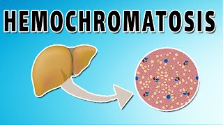 Hemochromatosis [upl. by Otrebile]