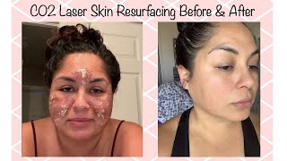 C02 Laser Resurfacing For Acne Scar Removal  My 7 Day Review [upl. by Tjon]